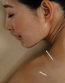 Acupuncture